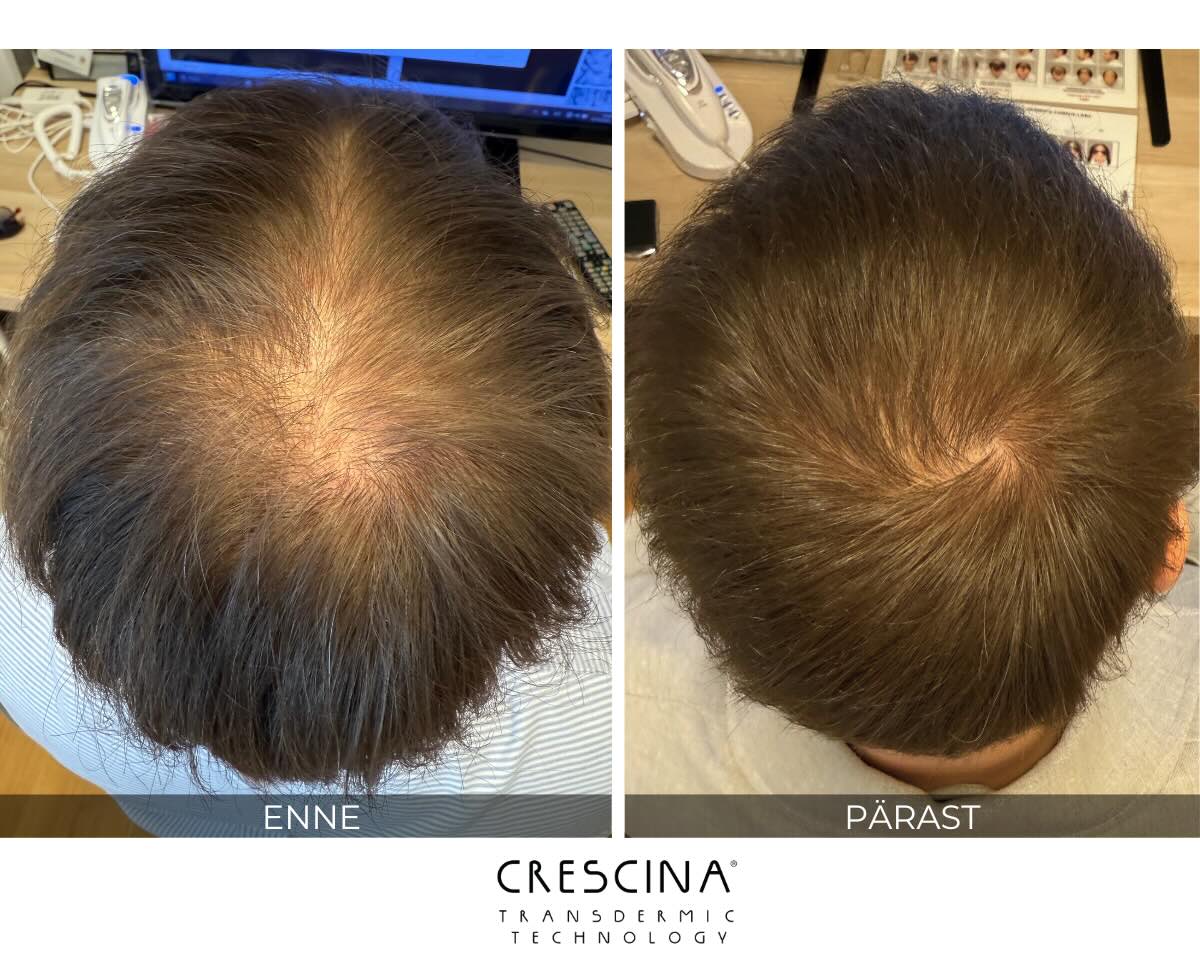 crescina tulemus ants rootslane