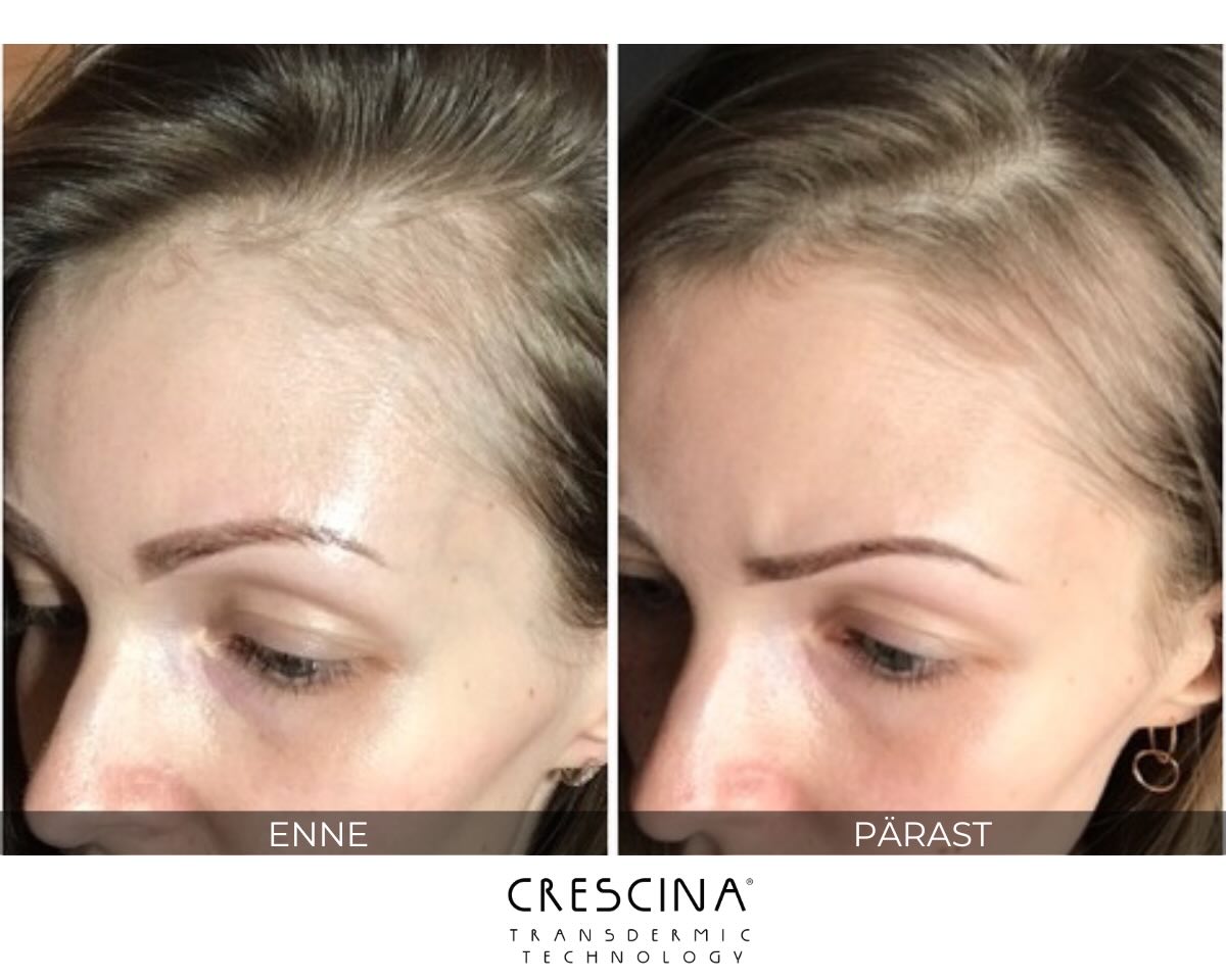 crescina-enne-parast