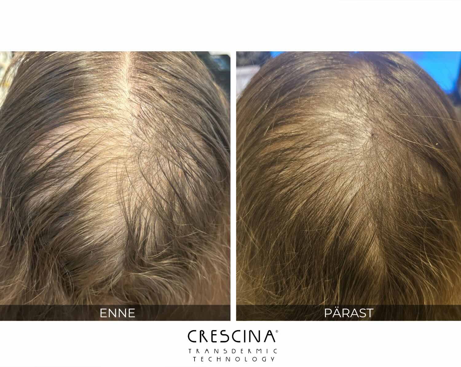 crescina_enne_parast_tulemused_triin