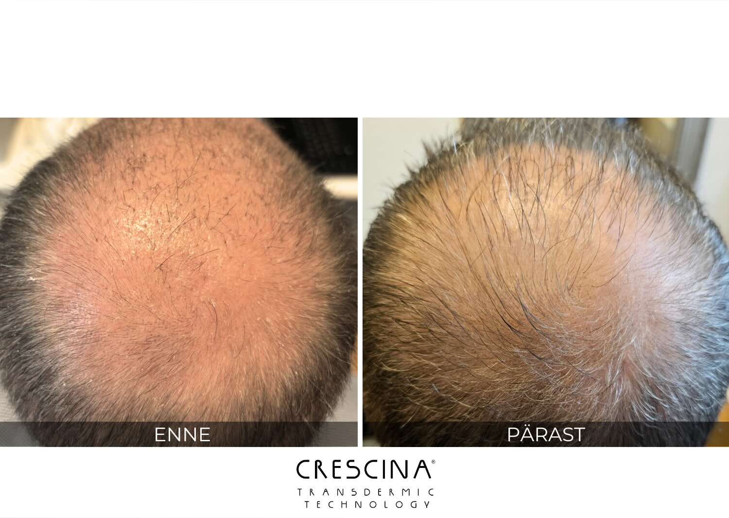 crescina-mehed-tulemus